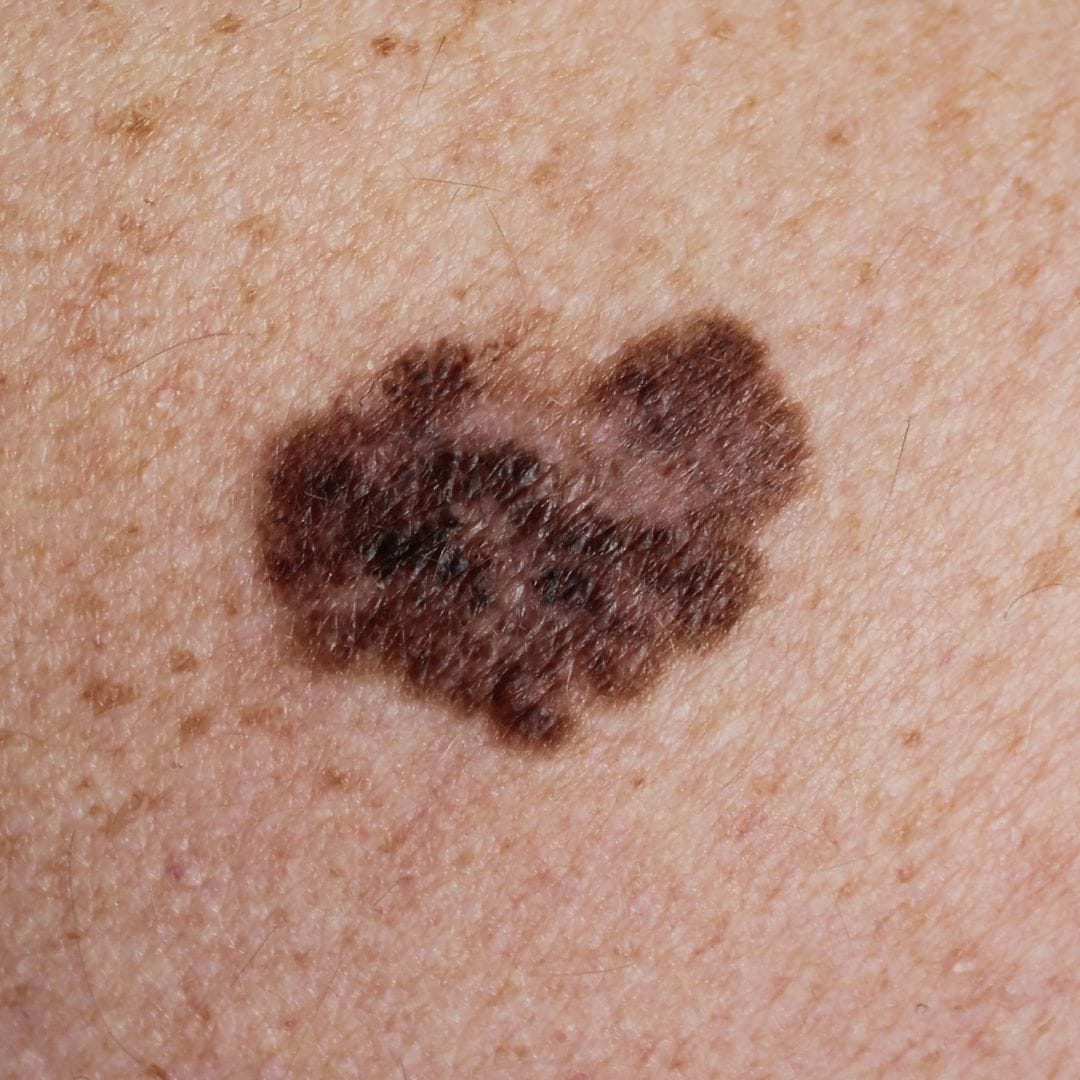 Auto-exame e melanoma, o que é e como tratar?